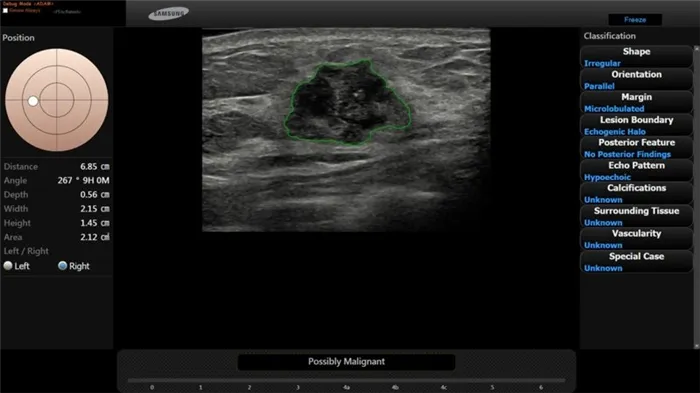 S-Detect Breast