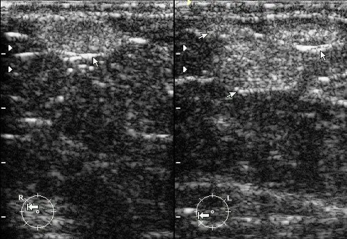Липомы молочной железы - овальные горизонтально ориентированные образования повышенной эхогенности с четкими ровными контурами